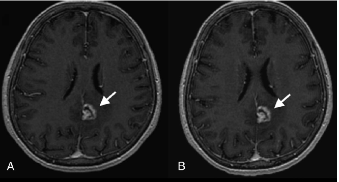 bendszus case cns